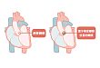 术式科普：什么是 TAVR 技术