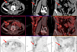 反复便血 6 年，PET/CT 找出真凶