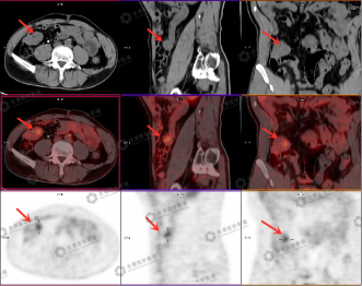 反复便血 6 年，PET/CT 找出真凶