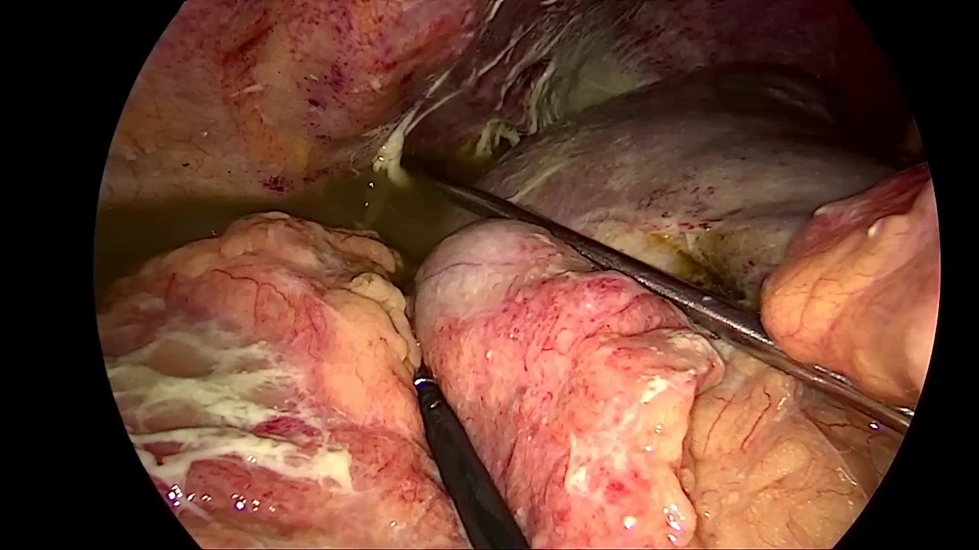 急性消化道穿孔诊治注意要点