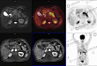 PET/CT-MR 增强异机融合在胰腺癌诊断中的使用价值