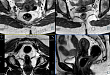 高分辨率 MRI 增强在直肠癌 T 分期中的临床应用