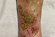 临床释疑：这样的皮肤溃疡不单纯