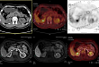PET/CT-MR 增强异机融合在原发性肝癌诊断中的使用价值
