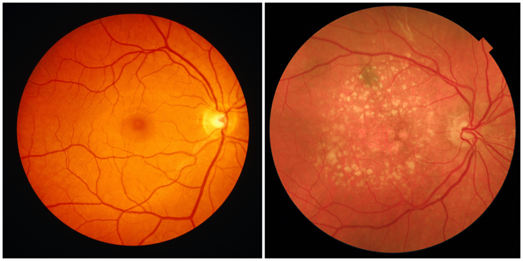 正常眼底          老年黄斑变性的眼底