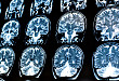 脑出血 MRI 信号变化记不住？这篇文章不要错过