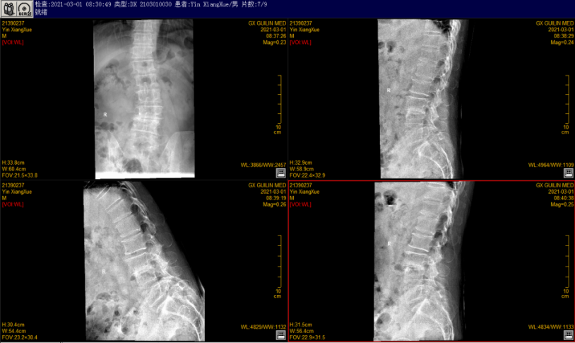 桂医附院：脊柱手术除了开放和微创，你还有新的选择