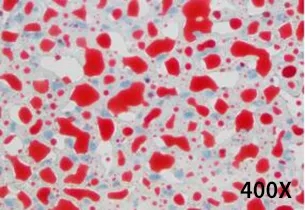 饮食诱导的非酒精性脂肪肝小鼠模型