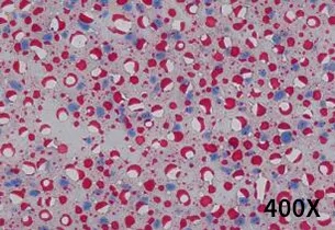 饮食诱导的非酒精性脂肪肝小鼠模型