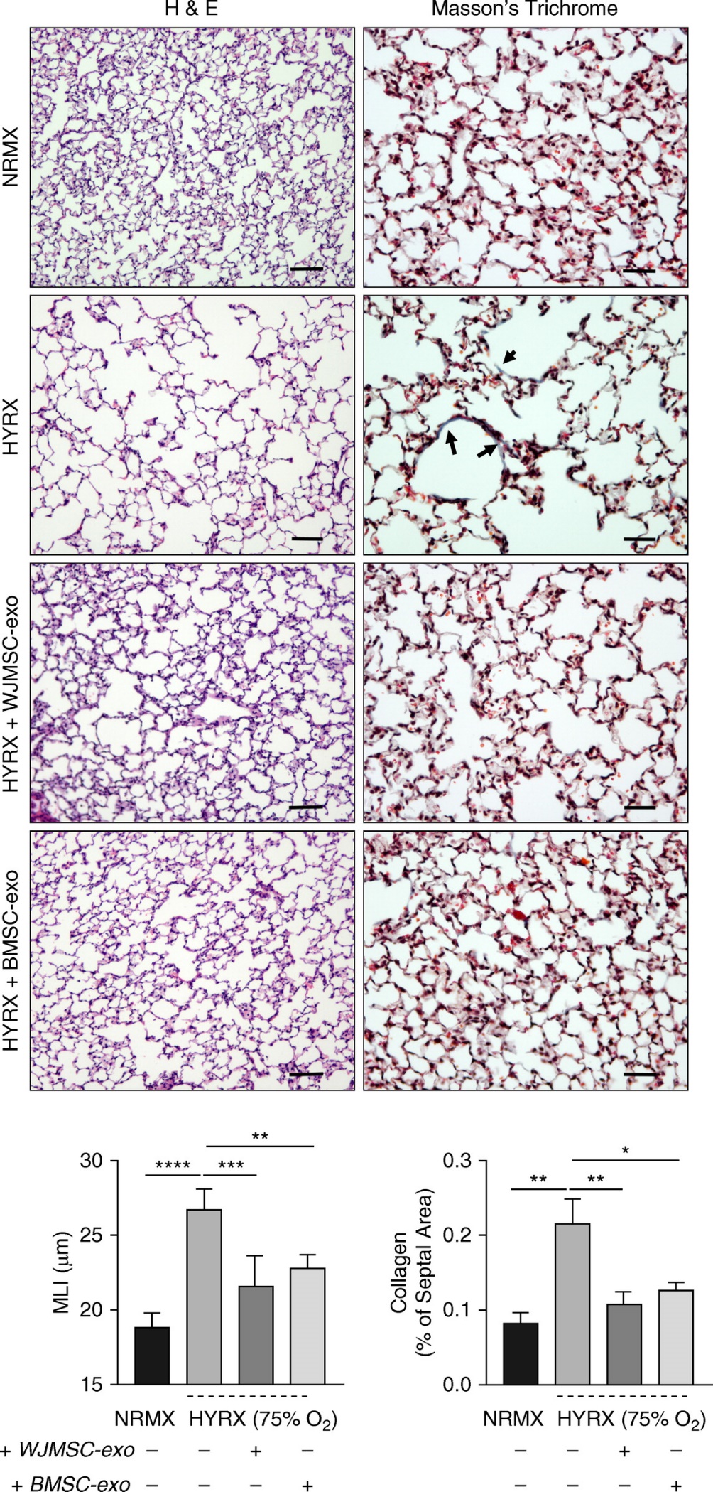 MSC来源的外泌体调节巨噬细胞免疫功能改善肺支气管发育不良恢复肺功能