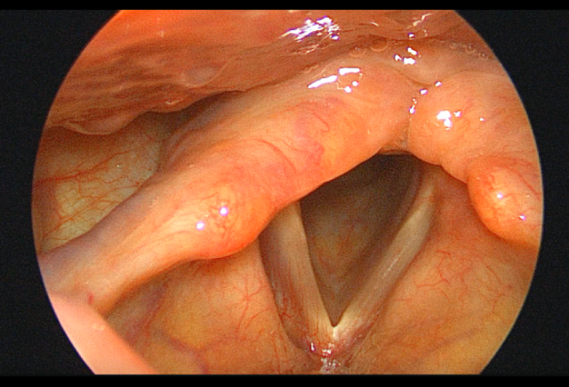 喉上神经麻痹患者一例2.png