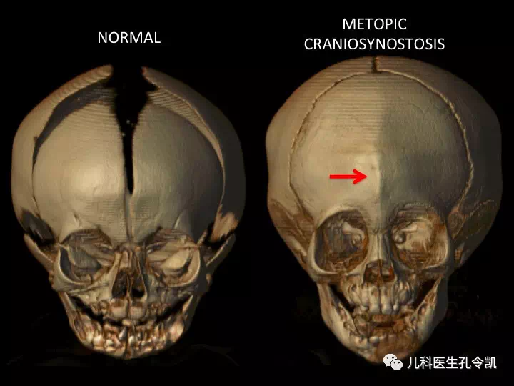 宝宝额头骨头凸起图片图片