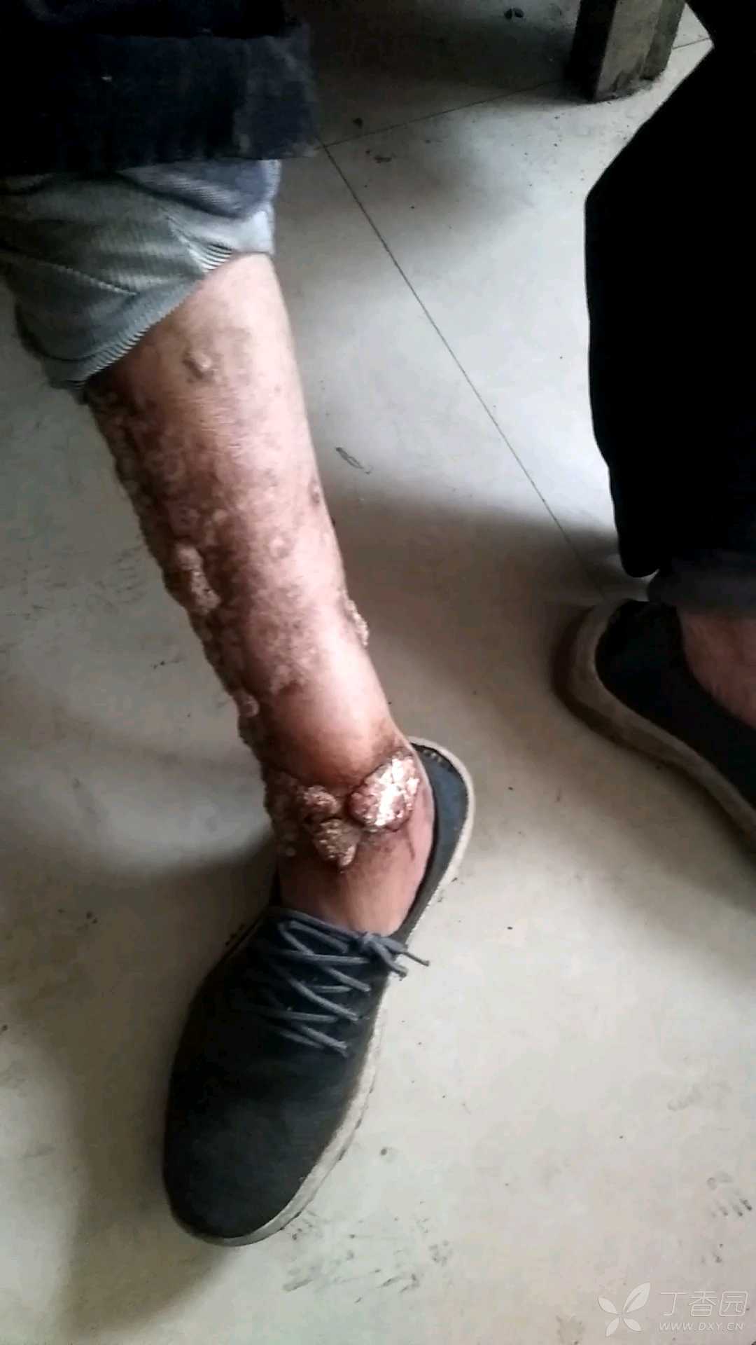 猜一猜:背部及四肢表皮异样增生,老年男性患者,病程两年,皮损处无明显