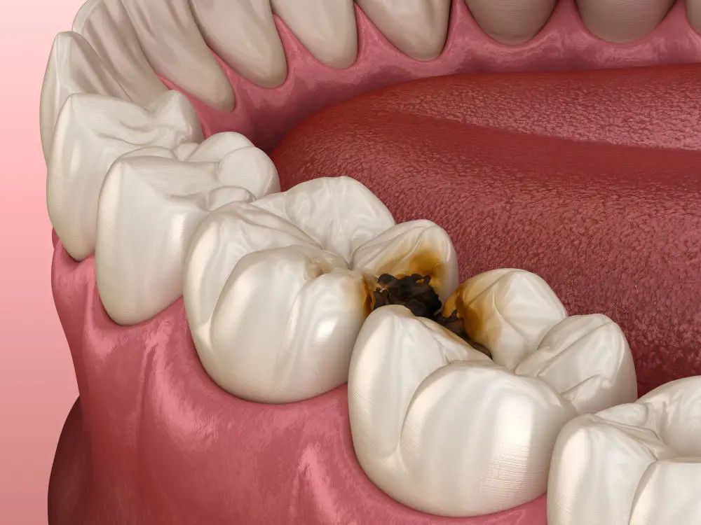 牙缝清洁没做好,你的牙齿很有可能会.