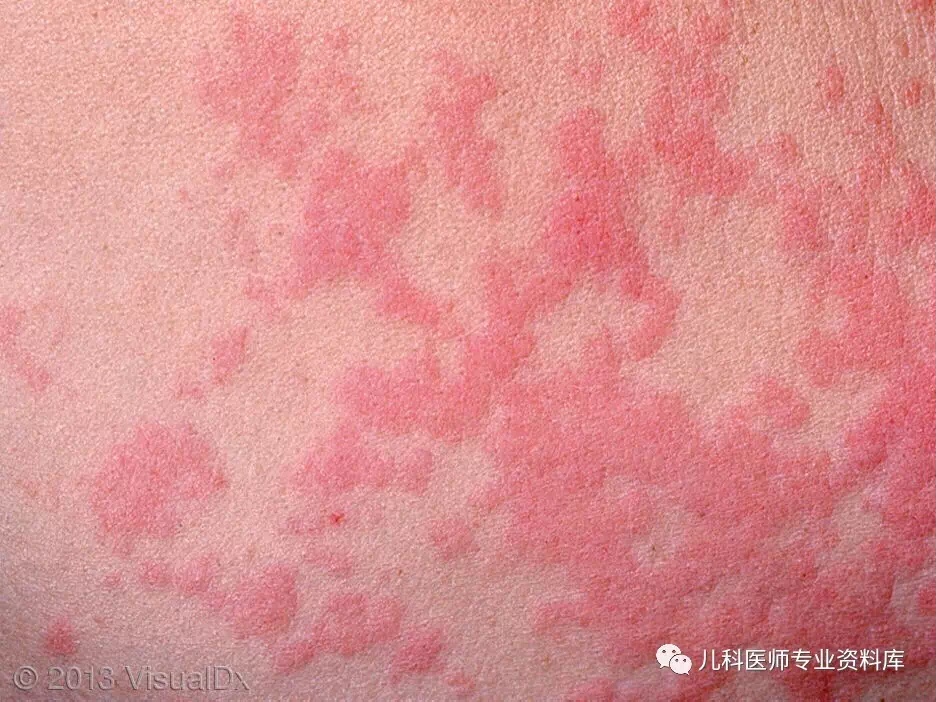 幼儿急疹、风疹、麻疹、猩红热、水痘、荨麻疹、热疹、湿疹等等，皮疹都是什么样子？怎么治疗和护理？