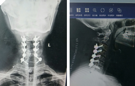 河南信合医院神经外科成功开展首例颈椎椎管狭窄减压术