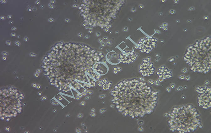 NK-92人恶性非霍奇金淋巴瘤患者的自然杀伤细胞