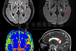 上海全景医学影像诊断中心：脑梗的这个征兆只有极少数人知道