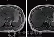 上海全景医学影像诊断中心告诉轻度脂肪肝的你：1 个坏消息，1 个好消息