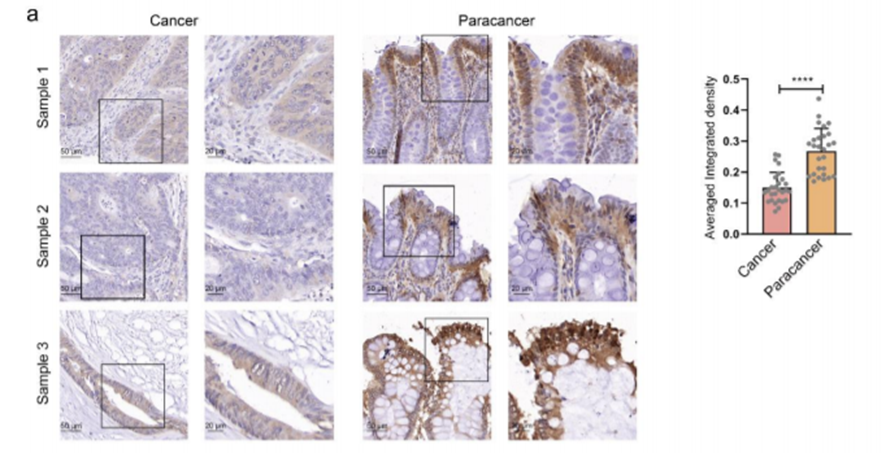 12+:预测癌症中改变自噬的基因突变
