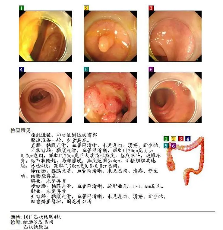 一周之内近 20 位，没有症状的结肠息肉会演变成结肠癌吗？