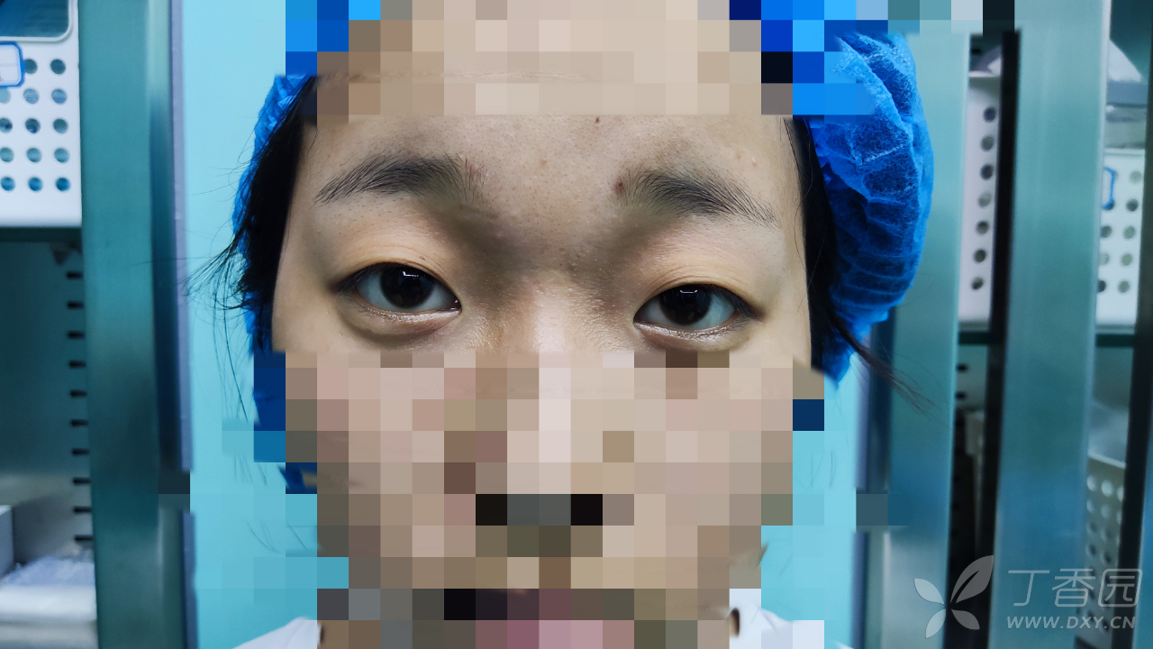 重睑术后眼睛闭合不全 修复重建和烧伤整形 丁香园论坛