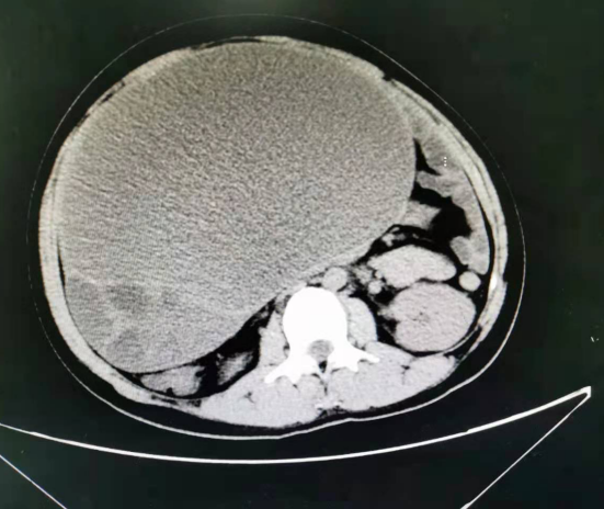 南昌大学第二附属医院妇产科陈琦教授团队完成一例巨型卵巢恶性肿瘤切除术