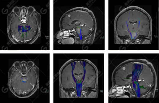 高尚病例：DTI 在颅脑占位病变中的应用
