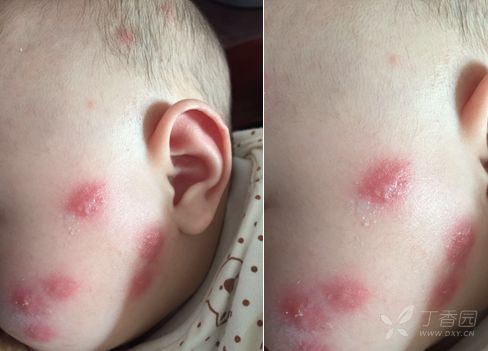 4个月婴儿荨麻疹图片图片