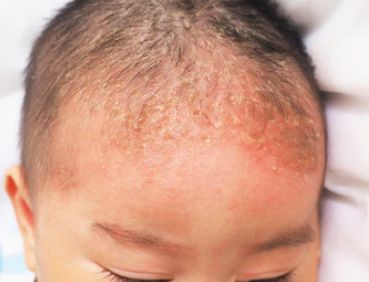患儿,男,2 个月,主因「头额部斑片状皮疹伴脱屑   d」来诊