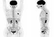 【病例分享】PET/CT 在乳腺与宫颈疾病诊断中的应用