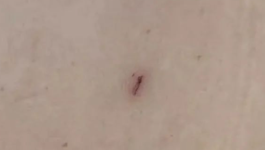 南京江北医院打响肾脏保卫战——1厘米的切口吸出数不清的小石头