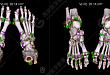 【病例分享】双能量 CT 诊断痛风石