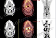 【病例分享】18 F-FDG PET/CT 在淋巴瘤疗效评估中的应用