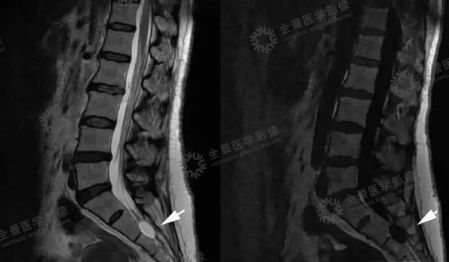 腰腿痛久治不愈，需要细查这个问题