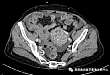 【病例分享】卵巢也会出现甲状腺肿？如何应对？