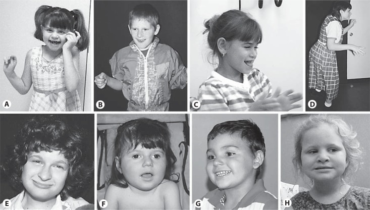 UBE3A基因敲除小鼠与天使综合征