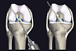 武汉首颐堂：膝关节前交叉韧带重建手术，术后跟踪对临床的启示