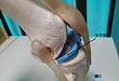 武汉首颐堂：膝关节半月板手术，术后跟踪对临床的启示
