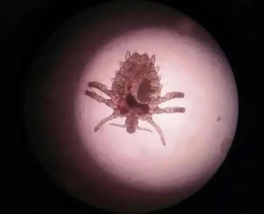 如果有疥疮久治不愈的困扰，你可以点进来看一看