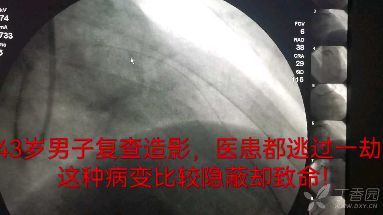 以为只是狭窄70%，实则冠脉夹层，ivus首日使用即立功（2）
