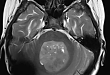 【病例分享】头痛、呕吐、步态不稳——警惕儿童颅内髓母细胞瘤的发生