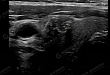 【病例分享】关注甲状腺癌筛查及其家族性