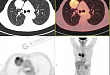 【病例分享】肺癌就诊，PET/CT 发现合并食管癌