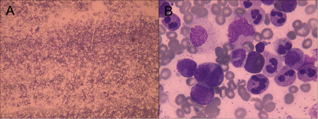 umol/l,,尿酸 842umol/l,維生素 b12>2000pg/m骨髓穿刺組織病理檢查