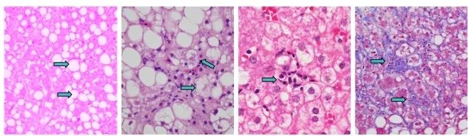 Sirt3基因敲除小鼠与非酒精性脂肪肝