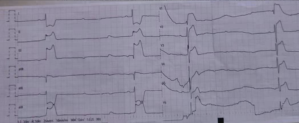 主动脉夹层心电图图片