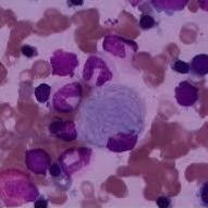 SNT8 人NK/T细胞淋巴瘤细胞