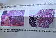 【病例分享】PET/CT 诊断少见部位脊索瘤一例