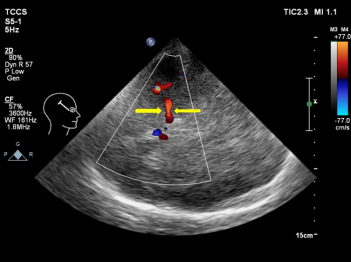 西南医科大学附属医院：「脑壳」可以用超声检查吗？